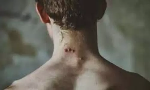Birth Mark: शरीर पर मौजूद कौन-कौन निशान खोलते हैं पिछले जन्म के राज