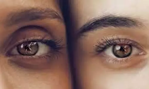 Dark circles:  डार्क सर्कल्स से छुटकारा पाने के लिए जरूर आजमाएं ये तरीका