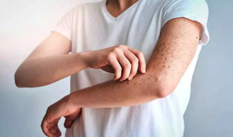 Skin Itching? राहत के लिए ये घरेलू उपाय आज़माएँ। Skin Itching? राहत के लिए ये घरेलू उपाय आज़माएँ।