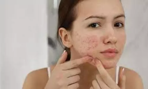 Beauty tips: पिंपल्स और डार्क स्पॉट्स से छुटकारा पाने के आसान उपाय Beauty tips: पिंपल्स और डार्क स्पॉट्स से छुटकारा पाने के आसान उपाय