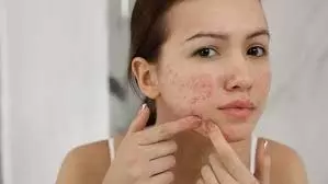 Beauty tips: पिंपल्स और डार्क स्पॉट्स से छुटकारा पाने के आसान उपाय Beauty tips: पिंपल्स और डार्क स्पॉट्स से छुटकारा पाने के आसान उपाय
