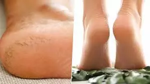 Foot Care in Winter: ठंड के मौसम में फट रही हैं एड़ियां, तो आजमाइए तो ये नुस्खे Foot Care in Winter: ठंड के मौसम में फट रही हैं एड़ियां, तो आजमाइए तो ये नुस्खे