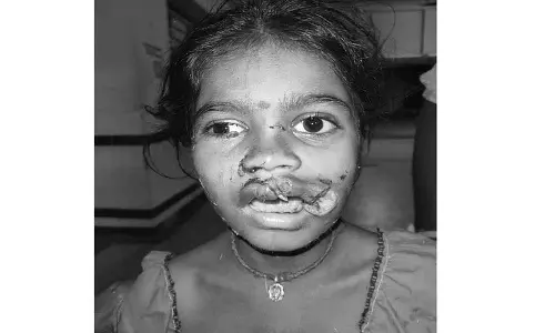 Stray dog के हमले में लड़की गंभीर रूप से घायल Stray dog के हमले में लड़की गंभीर रूप से घायल