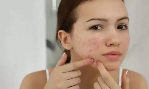 Acne या फुंसियां हमें क्यों होती हैं, इसके क्या कारण हैं? Acne या फुंसियां हमें क्यों होती हैं, इसके क्या कारण हैं?