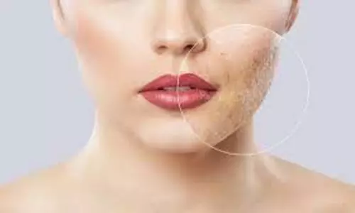 How to Remove Acne Scars: चेहरे के गड्ढे कर रहे हैं परेशान, इन आसान उपायों से पाएं बेदाग निखार