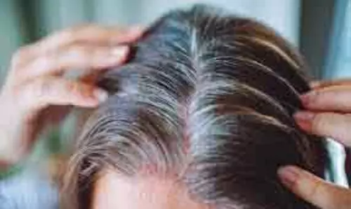 कम उम्र में Hair का सफेद होना बढ़ा चिंता का कारण कम उम्र में Hair का सफेद होना बढ़ा चिंता का कारण
