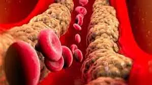 Cholesterol : डरना नहीं, समझकर नियंत्रण करना जरूरी Cholesterol : डरना नहीं, समझकर नियंत्रण करना जरूरी