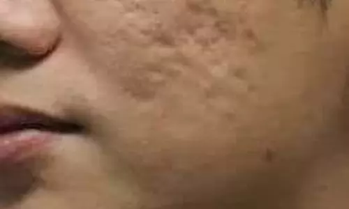 Beauty tips: पिंपल्स के बाद रह गए गड्ढे, बिना महंगे ट्रीटमेंट के इन तरीकों से पाएं स्मूद स्किन Beauty tips: पिंपल्स के बाद रह गए गड्ढे, बिना महंगे ट्रीटमेंट के इन तरीकों से पाएं स्मूद स्किन
