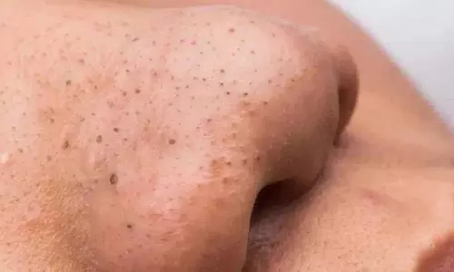 अगर आपको Blackheads की समस्या है तो ये घरेलू नुस्खे अपनाएं