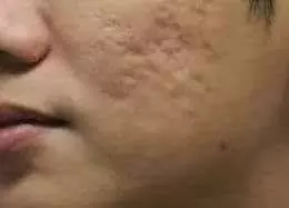 Beauty tips: पिंपल्स के बाद रह गए गड्ढे, बिना महंगे ट्रीटमेंट के इन तरीकों से पाएं स्मूद स्किन Beauty tips: पिंपल्स के बाद रह गए गड्ढे, बिना महंगे ट्रीटमेंट के इन तरीकों से पाएं स्मूद स्किन