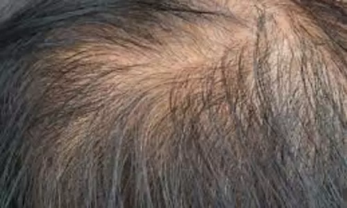 Hair Fall Control:  बालों का झड़ना रोकने और तुरंत रिजल्ट पाने के लिए 5 नैचुरल उपाय