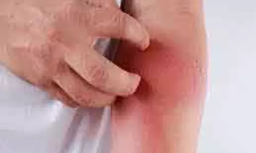Eczema: जानें आम ट्रिगर्स और बचाव के तरीके Eczema: जानें आम ट्रिगर्स और बचाव के तरीके