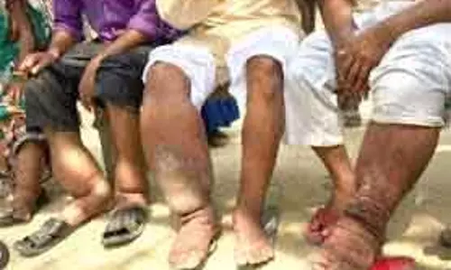 Odisha लिम्फेटिक फाइलेरियासिस को खत्म करने के लिए MDA के लिए तैयार