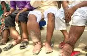 Odisha लिम्फेटिक फाइलेरियासिस को खत्म करने के लिए MDA के लिए तैयार Odisha लिम्फेटिक फाइलेरियासिस को खत्म करने के लिए MDA के लिए तैयार
