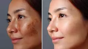 Skin Care Tips: ये एक नुस्खा गायब कर देगा चेहरे के दाग-धब्बे, आजमाकर जरूर देखें Skin Care Tips: ये एक नुस्खा गायब कर देगा चेहरे के दाग-धब्बे, आजमाकर जरूर देखें