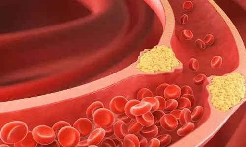High Cholesterol अगर आप इससे पीड़ित हैं तो ये खाद्य पदार्थ न लें High Cholesterol अगर आप इससे पीड़ित हैं तो ये खाद्य पदार्थ न लें