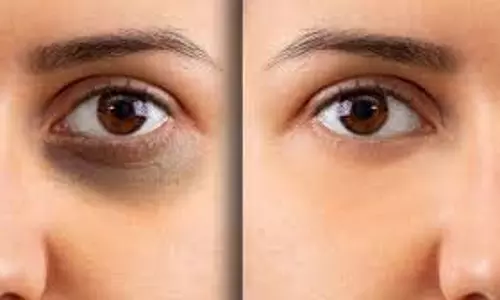Dark Circles Home Remedies: आंखों के नीचे काले घेरे कैसे हटाएं? आजमाएं ये असरदार घरेलू नुस्खे Dark Circles Home Remedies: आंखों के नीचे काले घेरे कैसे हटाएं? आजमाएं ये असरदार घरेलू नुस्खे