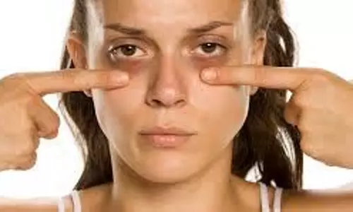 Dark Circles Removal Tips:  डार्क सर्कल्स हटाने के लिए असरदार घरेलू उपाय
