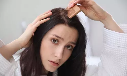 Cause Of Dandruff: डैंड्रफ अगर बार-बार लौट आता है, तो ये गलतियां हो सकती हैं वजह Cause Of Dandruff: डैंड्रफ अगर बार-बार लौट आता है, तो ये गलतियां हो सकती हैं वजह