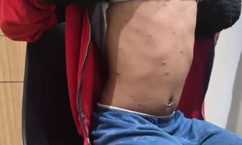 ठंड के मौसम में Chickenpox का प्रकोप: बदलते मौसम में देखभाल कैसे करें ठंड के मौसम में Chickenpox का प्रकोप: बदलते मौसम में देखभाल कैसे करें
