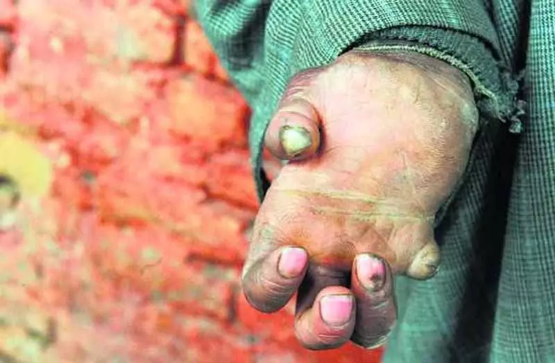 मल्टी-ड्रग थेरेपी से कुष्ठ रोग ठीक हो सकता है: District official मल्टी-ड्रग थेरेपी से कुष्ठ रोग ठीक हो सकता है: District official