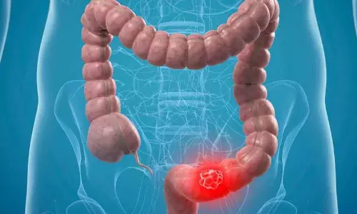 Colon Cancer के लक्षण जिनके बारे में आपको पता होना चाहिए और इन टिप्स को फॉलो करना चाहिए Colon Cancer के लक्षण जिनके बारे में आपको पता होना चाहिए और इन टिप्स को फॉलो करना चाहिए