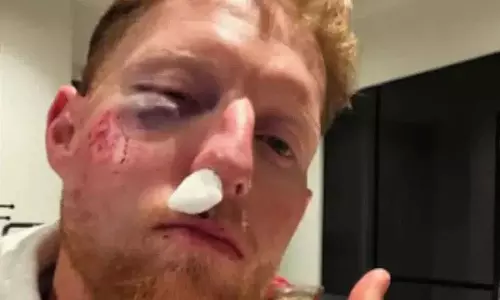 ट्रेनिंग सेशन के दौरान चेहरा फ्रैक्चर हुआ.. Ben Stokes गंभीर रूप से घायल
