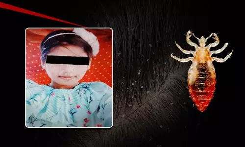 जूँ का संक्रमण सिर तक फैल गया, Puri में 12 साल की लड़की की जान चली गई जूँ का संक्रमण सिर तक फैल गया, Puri में 12 साल की लड़की की जान चली गई