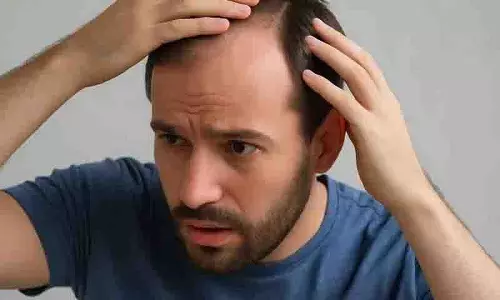 पुरुषों में Hair Fall के क्या कारण हैं? क्या करें? पुरुषों में Hair Fall के क्या कारण हैं? क्या करें?