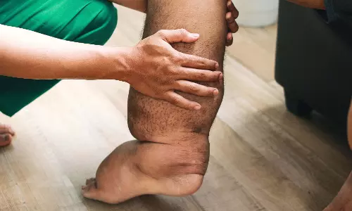 फाइलेरिया उन्मूलन महाभियान, कलेक्टर लंगेह ने दवा खिलाकर किया शुभारंभ