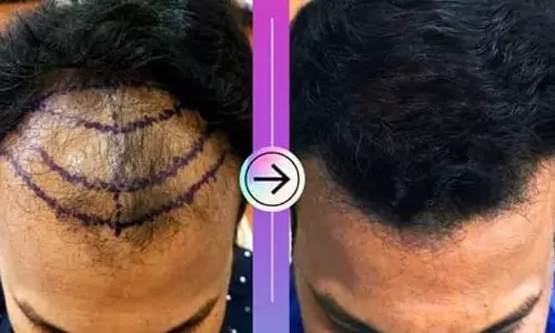 नकली डॉक्टरों द्वारा Hair ट्रांसप्लांट ट्रीटमेंट: मॉनिटरिंग की समस्या नकली डॉक्टरों द्वारा Hair ट्रांसप्लांट ट्रीटमेंट: मॉनिटरिंग की समस्या