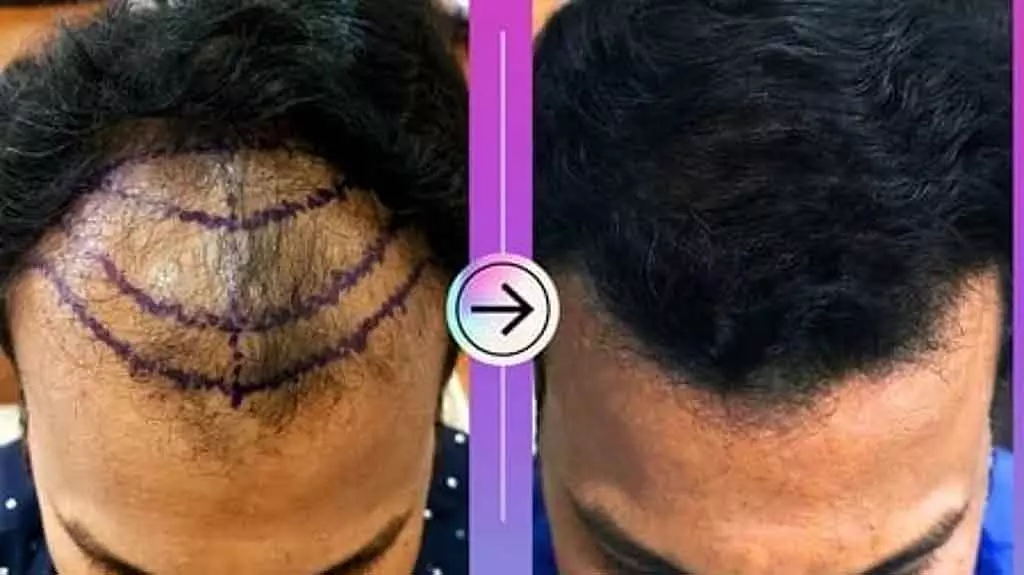 नकली डॉक्टरों द्वारा Hair ट्रांसप्लांट ट्रीटमेंट: मॉनिटरिंग की समस्या नकली डॉक्टरों द्वारा Hair ट्रांसप्लांट ट्रीटमेंट: मॉनिटरिंग की समस्या
