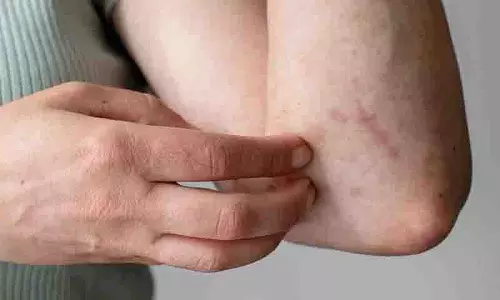 Diabetes के लक्षण स्किन पर दिखने पर डॉक्टर से सलाह ज़रूर लें Diabetes के लक्षण स्किन पर दिखने पर डॉक्टर से सलाह ज़रूर लें