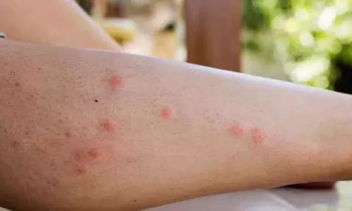 अगर आपको Mosquitoes काट रहे हैं तो ये करें अगर आपको Mosquitoes काट रहे हैं तो ये करें