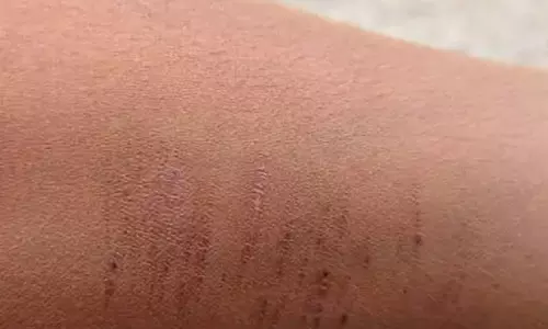 मीडिल स्कूल में चौंकाने वाली घटना: 35 बच्चों ने ब्लेड, पिन और कांटों से काटे हाथ मीडिल स्कूल में चौंकाने वाली घटना: 35 बच्चों ने ब्लेड, पिन और कांटों से काटे हाथ