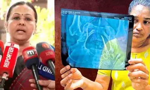 surgery के 5 साल बाद महिला के पेट में सर्जिकल कैंची मिली surgery के 5 साल बाद महिला के पेट में सर्जिकल कैंची मिली