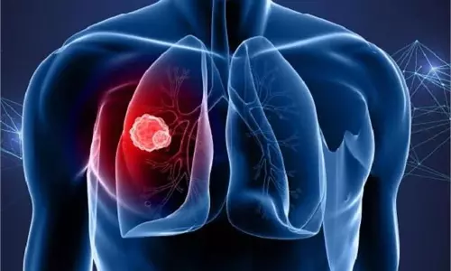 Lung Cancer: शरीर में न करें इन लक्षणों को नज़र अंदाज़ हो सकता है फेफड़ों का कैंसर Lung Cancer: शरीर में न करें इन लक्षणों को नज़र अंदाज़ हो सकता है फेफड़ों का कैंसर