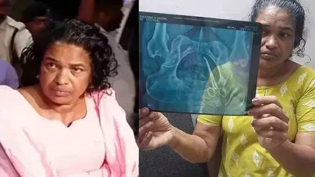 kerala: महिला के पेट से फोरसेप्स मिलने पर जांच रिपोर्ट में डॉक्टर को बरी किया गया kerala: महिला के पेट से फोरसेप्स मिलने पर जांच रिपोर्ट में डॉक्टर को बरी किया गया