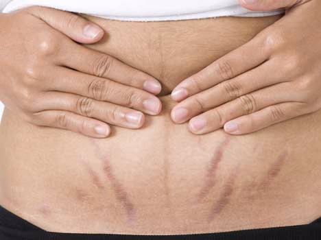Health: स्ट्रेच मार्क्स कम करने के प्राकृतिक तरीके