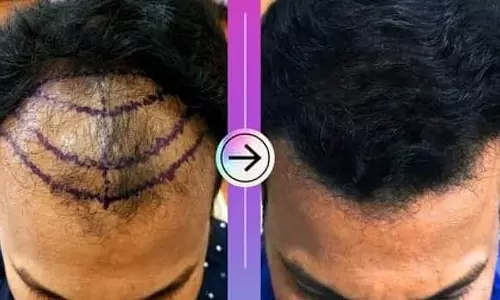 Public हेल्थ डिपार्टमेंट ने हेयर ट्रांसप्लांट सेंटर्स पर रोक लगाने के लिए नए नियम बनाए