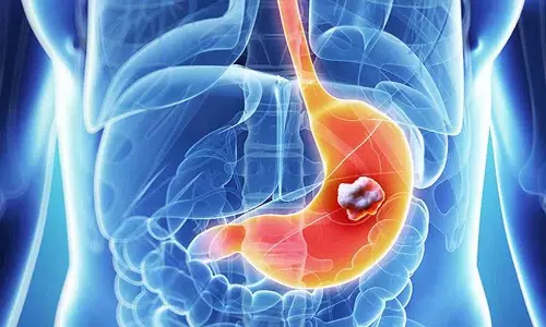 Stomach Cancer के शुरुआती लक्षण अगर आपको हैं तो नज़रअंदाज़ न करें