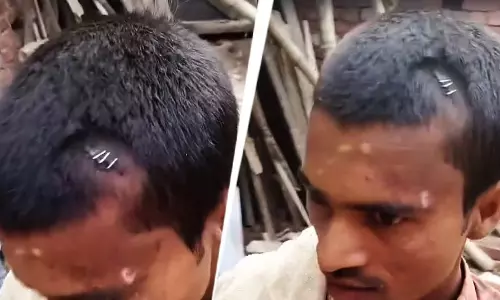 डॉक्टर ने घायल युवक के चोटिल जगह में लगाया स्टेपलर पिन, गिरफ्तारी जल्द