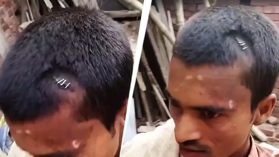 डॉक्टर ने घायल युवक के चोटिल जगह में लगाया स्टेपलर पिन, गिरफ्तारी जल्द डॉक्टर ने घायल युवक के चोटिल जगह में लगाया स्टेपलर पिन, गिरफ्तारी जल्द