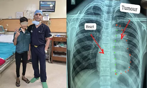 दिल से चिपका दुर्लभ कैंसर निकाला, मेकाहारा के डॉक्टरों ने 11 साल के बच्चे को नई जिंदगी दी दिल से चिपका दुर्लभ कैंसर निकाला, मेकाहारा के डॉक्टरों ने 11 साल के बच्चे को नई जिंदगी दी
