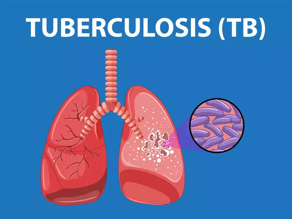 ओडिशा में TB जानलेवा हो गया; 3 साल में करीब 1 लाख मरीज पूरी तरह ठीक नहीं हुए ओडिशा में TB जानलेवा हो गया; 3 साल में करीब 1 लाख मरीज पूरी तरह ठीक नहीं हुए