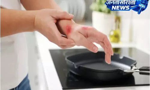 किचन बर्न्स: पक्के निशान से बचने के लिए अपनी स्किन का ध्यान कैसे रखें? किचन बर्न्स: पक्के निशान से बचने के लिए अपनी स्किन का ध्यान कैसे रखें?