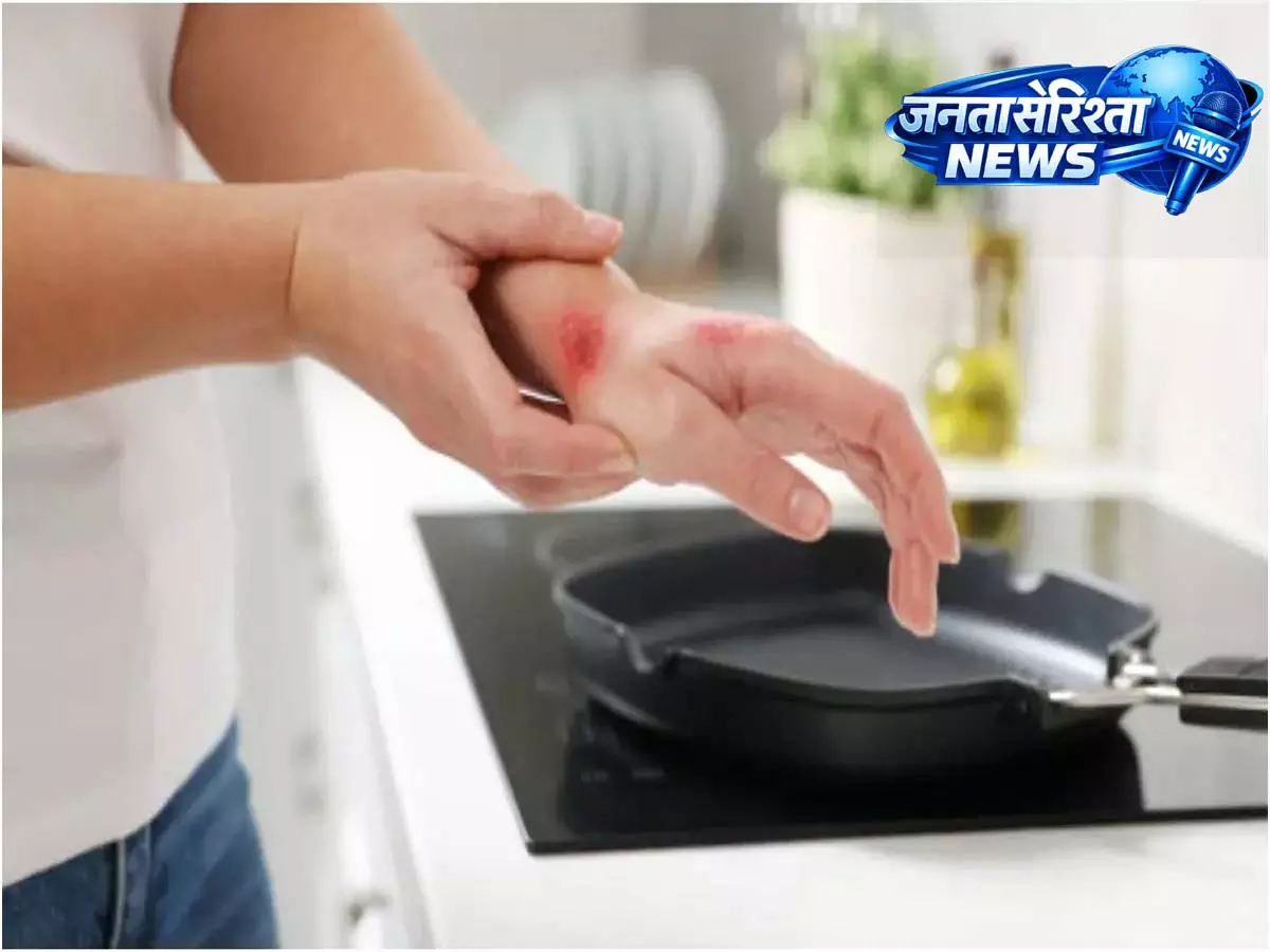 किचन बर्न्स: पक्के निशान से बचने के लिए अपनी स्किन का ध्यान कैसे रखें? किचन बर्न्स: पक्के निशान से बचने के लिए अपनी स्किन का ध्यान कैसे रखें?