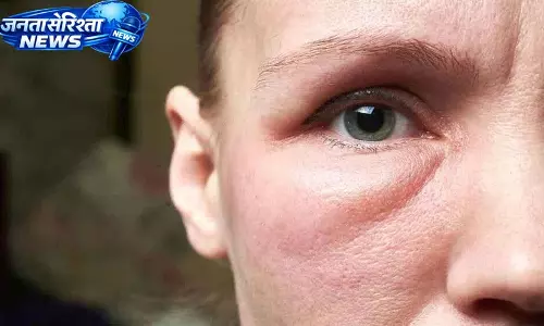 Face पर सूजन क्या है, यह कैसे होती है और इसे कम करने के लिए क्या करें Face पर सूजन क्या है, यह कैसे होती है और इसे कम करने के लिए क्या करें