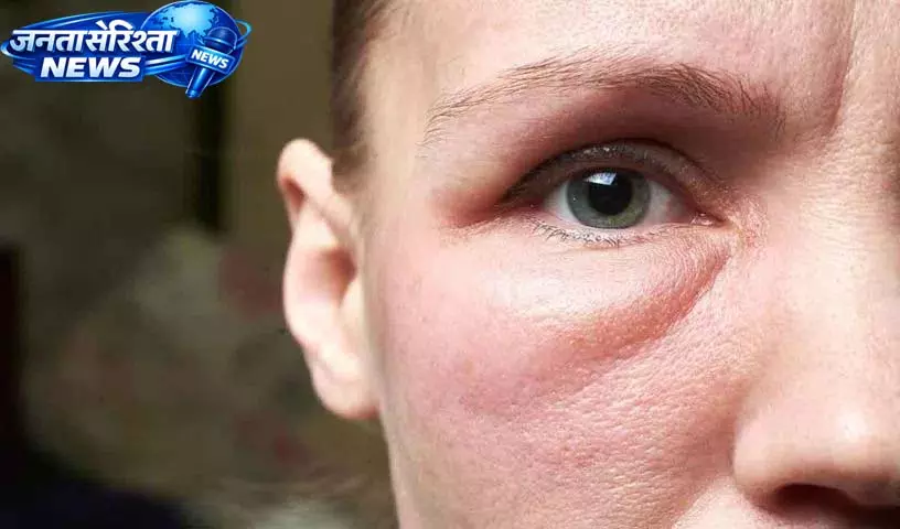 Face पर सूजन क्या है, यह कैसे होती है और इसे कम करने के लिए क्या करें Face पर सूजन क्या है, यह कैसे होती है और इसे कम करने के लिए क्या करें