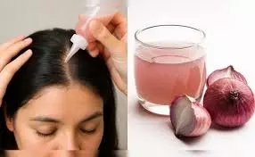 हेयर फॉल से छुटकारा: प्याज के रस में मिलाएं ये 2 घरेलू चीजें, मिलेगा बेहतर रिजल्ट हेयर फॉल से छुटकारा: प्याज के रस में मिलाएं ये 2 घरेलू चीजें, मिलेगा बेहतर रिजल्ट